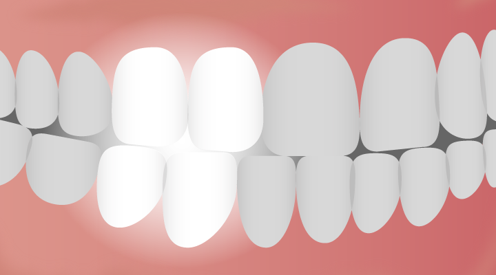 The-In-between-Tooth-Guide-to-Bicuspids_720x400 The bicuspid tooth is sometimes called a premolar because of its positioning between the canine teeth and molars.