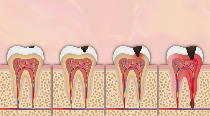 Learn how researchers found that environmental factors seem to be the prime cause of cavities — not genetic makeup.