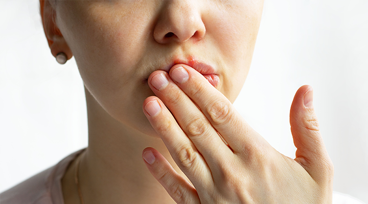winter-chapped-lips-720 winter-chapped-lips-720